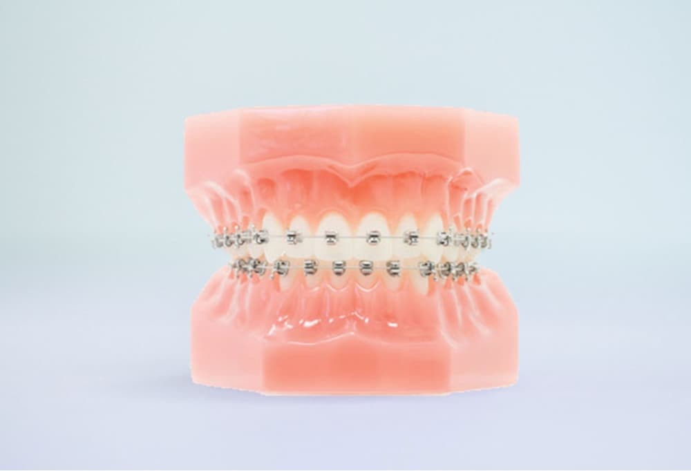 metal braces on plastic model