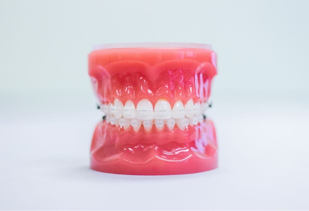clear braces on plastic model